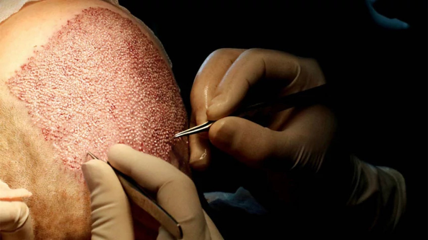 4 Days Hair Transplantation & City Package Tour photo 1
