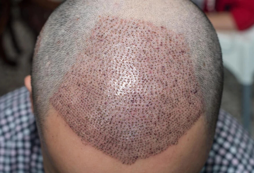 5 Days Istanbul City Tour and Hair Transplant Program photo 4