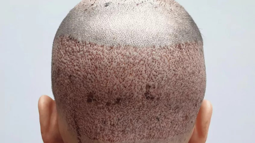 5 Days Istanbul City Tour and Hair Transplant Program photo 6