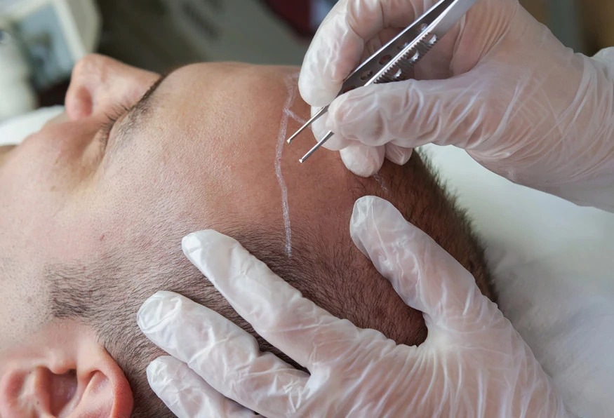 5 Days Istanbul City Tour and Hair Transplant Program photo 8