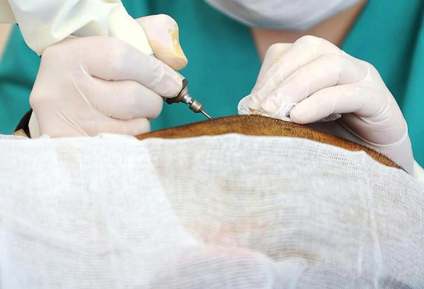 4 Days Hair Transplantation & City Package Tour photo 6