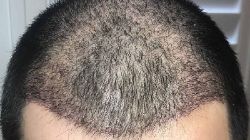 3 Days Istanbul City Tour and Hair Transplant Package photo 2