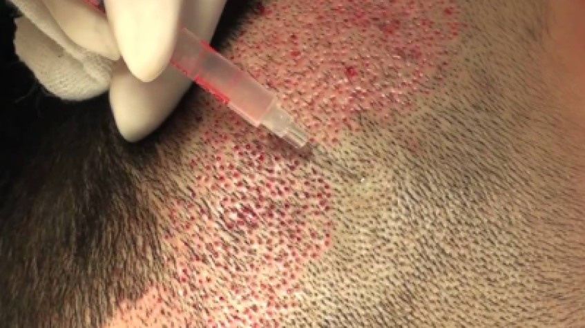 3 Days Istanbul City Tour and Hair Transplant Package photo 3