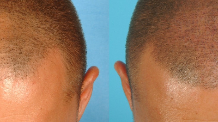 3 Days Istanbul City Tour and Hair Transplant Package photo 4